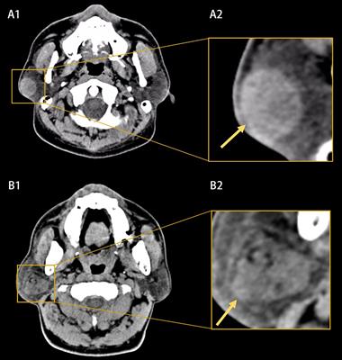 Using deep learning to distinguish malignant from benign parotid tumors on plain computed tomography images